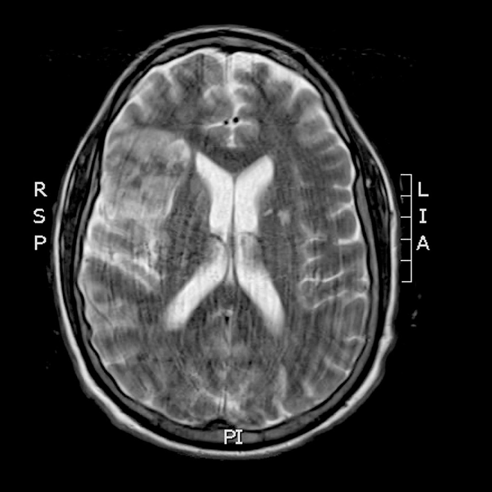 Magnetic resonance image of the brain showing right middle cerebral artery infarction on 2-week follow-up imaging.