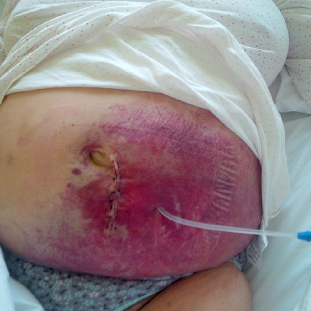 The abdominal wall hematoma after Tenckhoff catheter implantation on day 1.