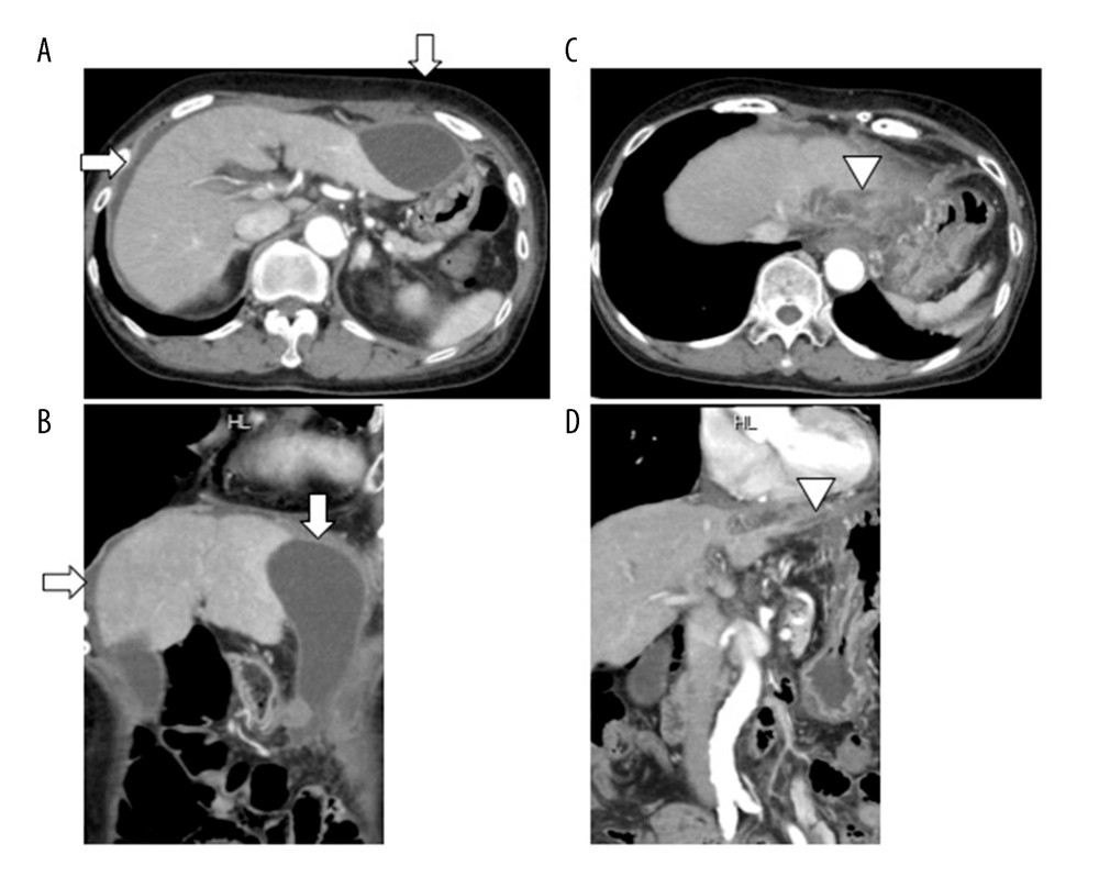 (A, B) Abdominal enhanced computed tomography (CT) of the liver showing fluid adjacent to the lateral segment and a small amount of ascites surrounding the right lobe (white arrows). (C, D) Abdominal enhanced CT showing common bile duct dilatation and localized cholangiectasia of B2 with a slight high-density area in the lower stream of B2 (arrowheads).