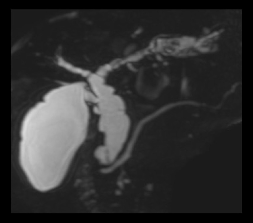 Magnetic resonance cholangio-pancreatography (MRCP) showing common bile duct (CBD) dilatation with filling defects, and narrowing and irregularity of intrahepatic bile ducts accompanied by cholangiectasia of segment B2 and defects that suggest intrahepatic choledocholithiasis.