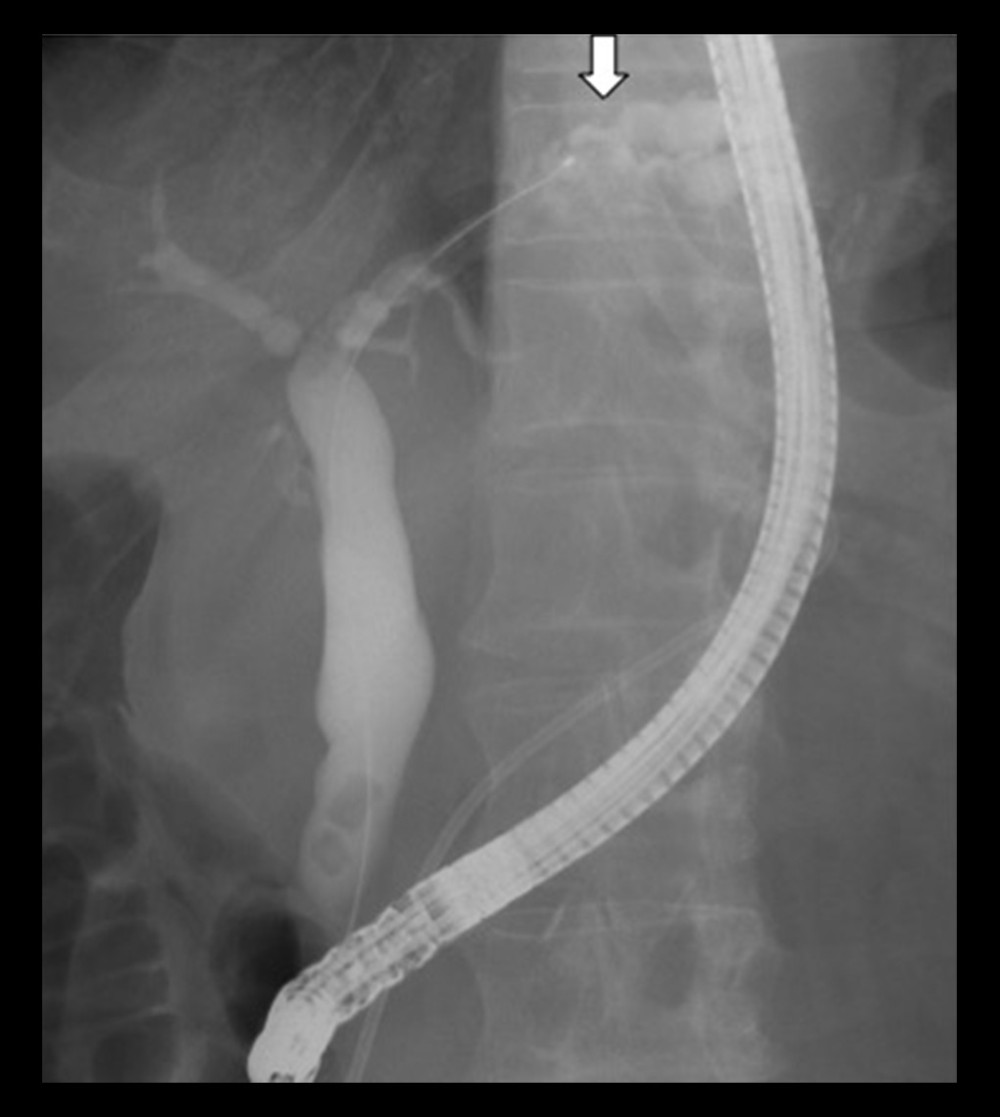 Endoscopic retrograde cholangio-pancreatography (ERCP) showing several filling defects in the left hepatic duct and segment B2 with dilatation (white arrow).