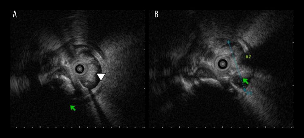 Intraductal ultrasonography (IDUS) showing cholangiolithiasis at the confluence of segments B2 and B3 (arrows), and soft-tissue shadows (arrowhead) in the intrahepatic bile duct of segment B2.