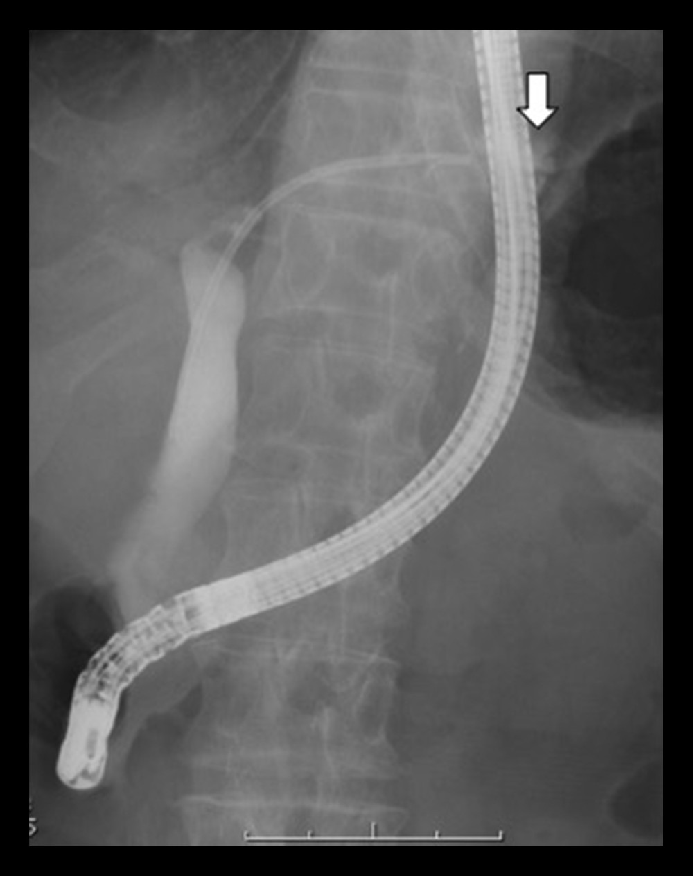 Cholangiography via the endoscopic nasobiliary drain (ENBD) showing bile leakage from the B2 segment periphery outside the liver (white arrow).