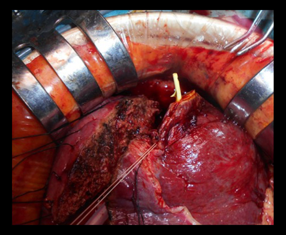 Intraoperative findings. An indwelling endoscopic retrograde biliary drain (ERBD) tube, placed preoperatively into B2, is located outside the edge of the lateral segment, which indicates that the appendix fibrosa hepatis was the perforation site.