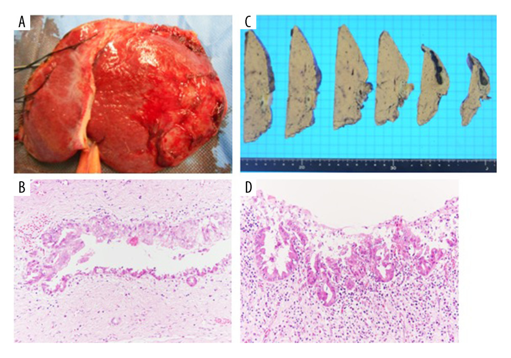 The histopathological diagnosis was intraductal cholangiocellular carcinoma with intrahepatic cholangiolithiasis. (A) Surgical specimen, (B) Formalin-fixed specimen, (C) Hematoxylin-eosin (HE) staining, low-power field, (D) High-power field.