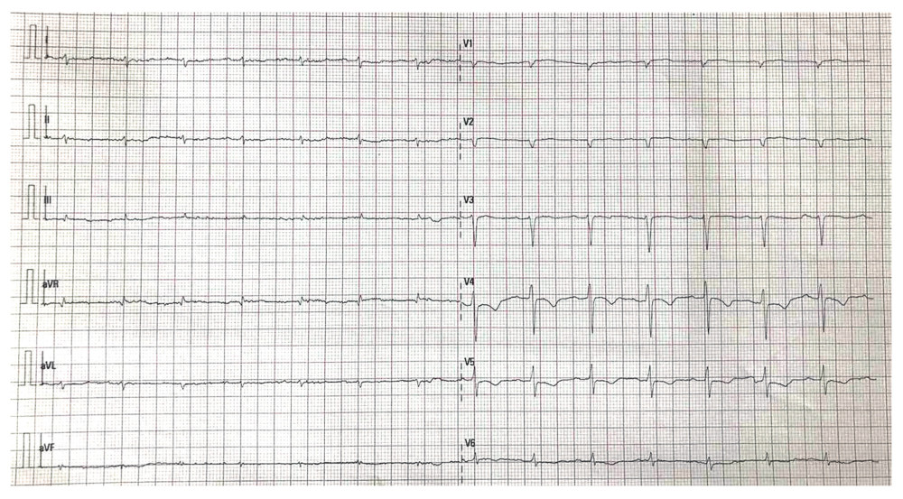 An electrocardiogram from Patient 1 showing microvoltage in the limb leads and a pseudoinfarction pattern in the precordial leads.