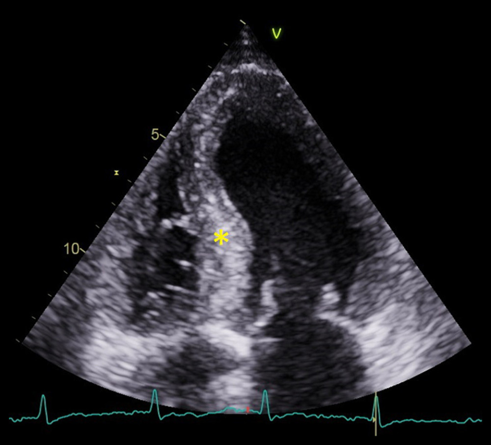 An echo image (apical 4 chamber view) from Patient 1. The asterisk marks the myocardium of the left ventricle, which is speckled and appears to be hypertrophic.