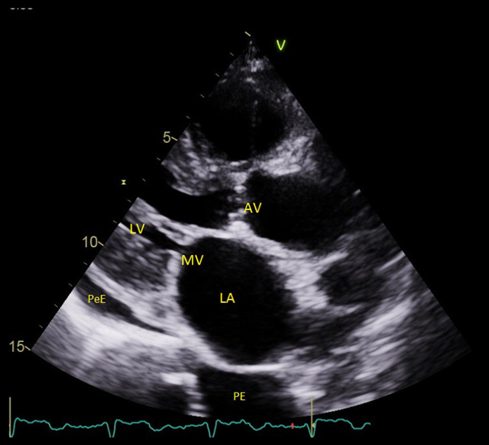 An echo image (parasternal long axis view) from Patient 2. The left ventricle is small, the left atrium is enlarged, the valves are thickened, and there is a small amount of pericardial and plural effusion. AV – aortic valve; LA – left atrium; LV – left ventricle; MV – mitral valve; PeE – pericardial effusion; PE – plural effusion.