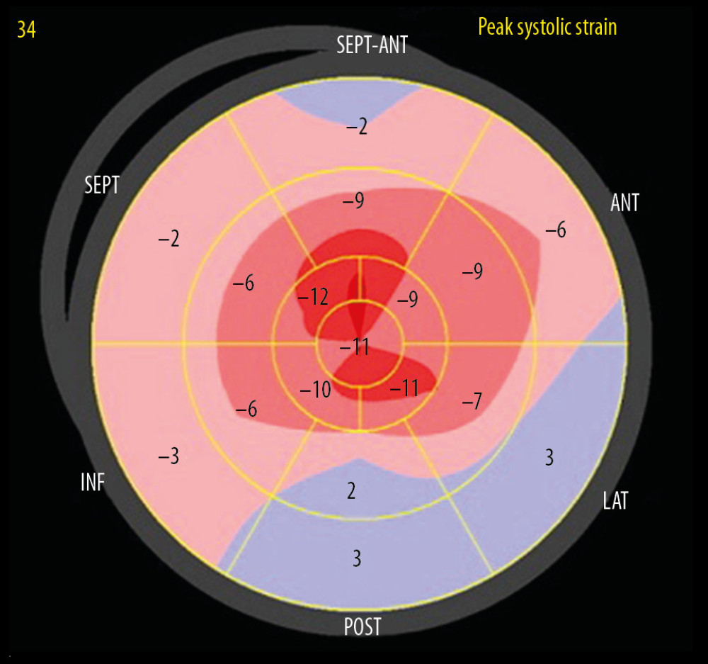 A bullseye display of regional LV longitudinal strain from Patient 2. The basal regions are outermost, mid regions in the middle, and apical regions innermost. A significant reduction in longitudinal strain, with a typical “apical-sparing” or “cherry-on-top” pattern is seen.