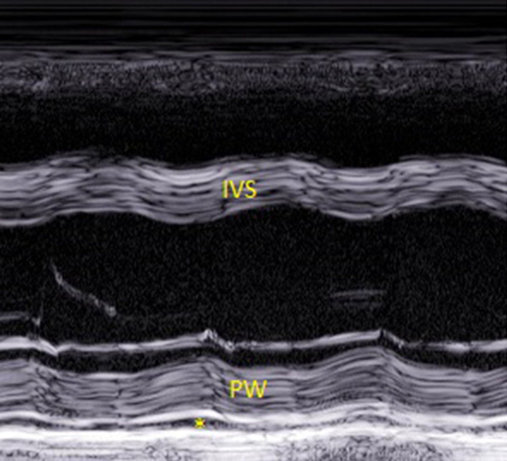 An echo image (parasternal long axis view, M mode tracing) from Patient 3. The septum of the left ventricle and posterior wall have a layered appearance (“onion bulb”). A small amount of pericardial effusion is visible behind the posterior wall (asterisk). IVS – intraventricular septum; PW – posterior wall.