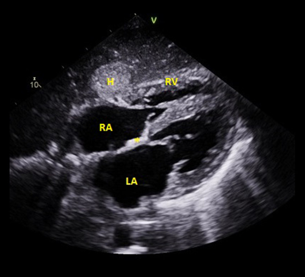 An echo image (subcostal view) from Patient 3. The left and right atrium are both enlarged, the interatrial septum (asterisk) is thickened, and the wall of the right ventricle exhibits “hypertrophy.”. A liver hemangioma was an incidental finding. H – hemangioma; LA – left atrium; RA – right atrium; RV – right ventricle.