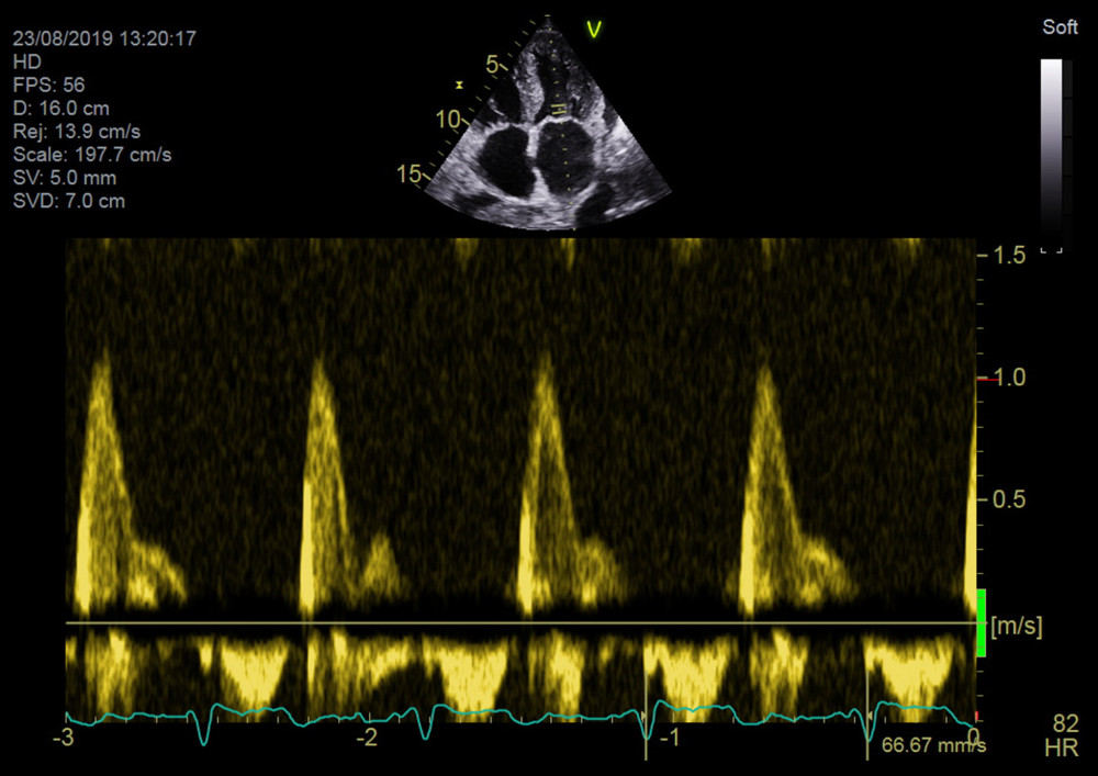 An echo image (apical 4-chamber view) from Patient 3. The Doppler tracing of transmitral flow shows a restrictive left ventricular filling pattern.