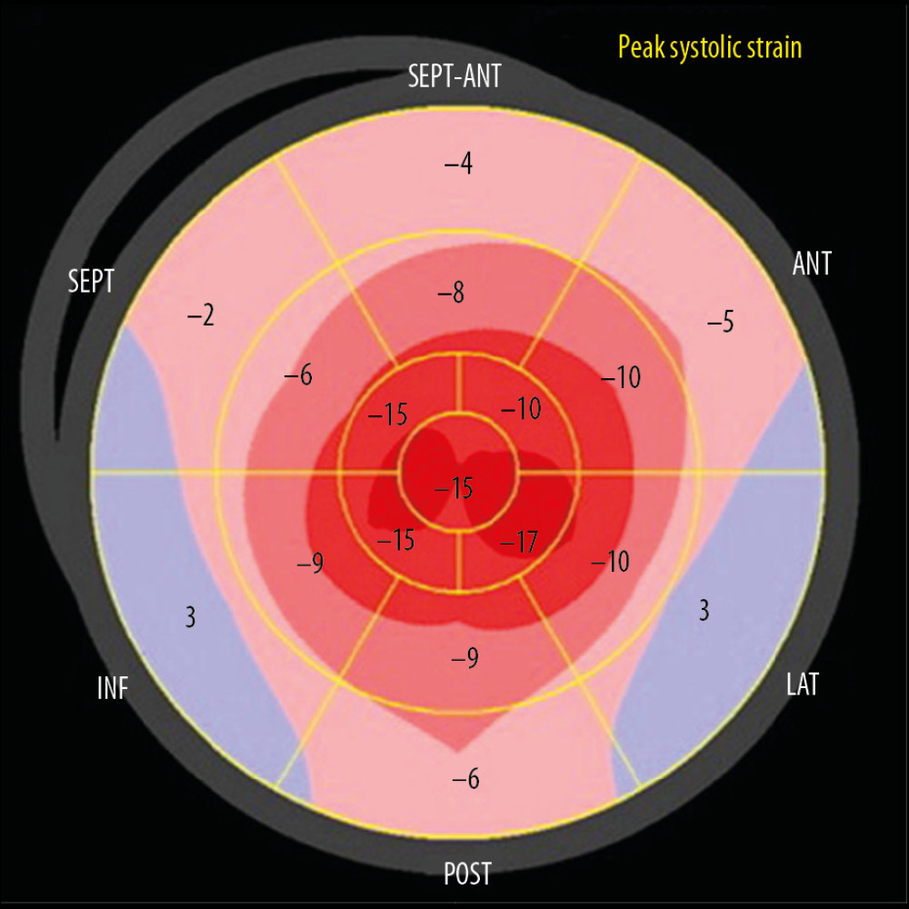 A bullseye display of the regional LV longitudinal strain from Patient 3. The pattern of strain reduction is the same as in Figure 8, but less prominent.