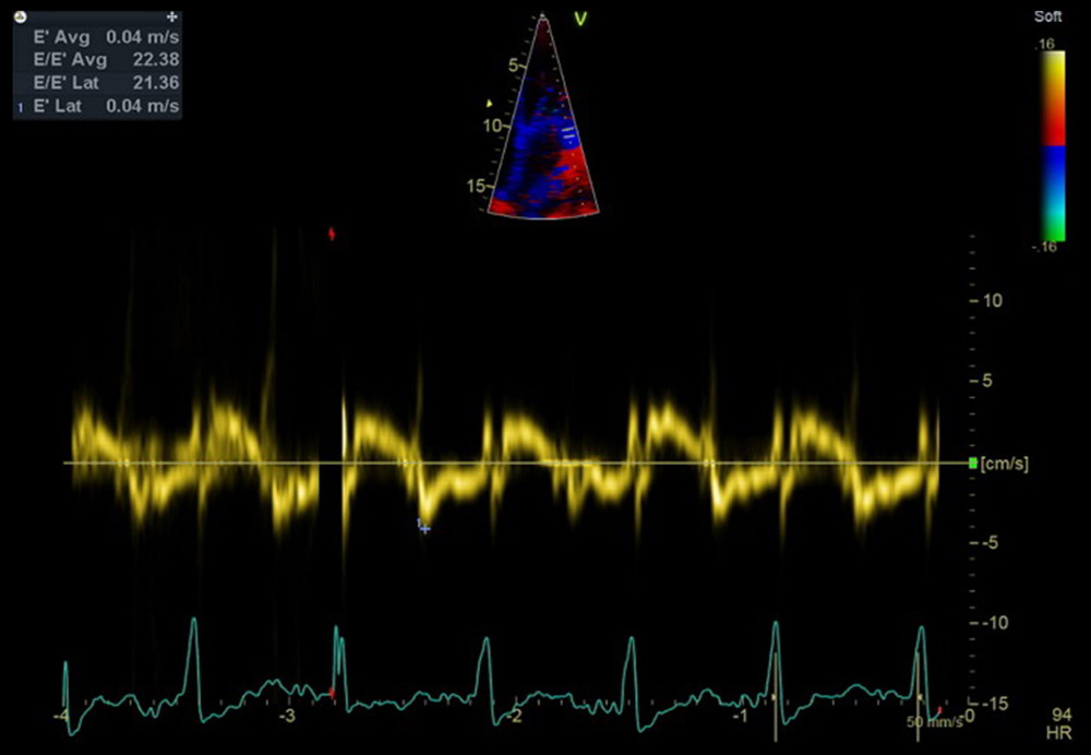 An echo image (modified apical 4-chamber view) from Patient 3. The low tissue Doppler mitral annulus velocity and increased E/e’ are consistent with restrictive cardiomyopathy.