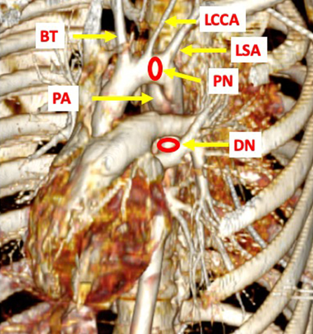 Trauma scan CTA. BT – brachiocephalic trunk; DN – distal neck (12 mm in diameter); LCCA – left common carotid artery; LSA – left subclavian artery; PN – proximal neck (12.5 mm in diameter); PA – pseudoaneurysm. * See at dimensions of vertebra body.