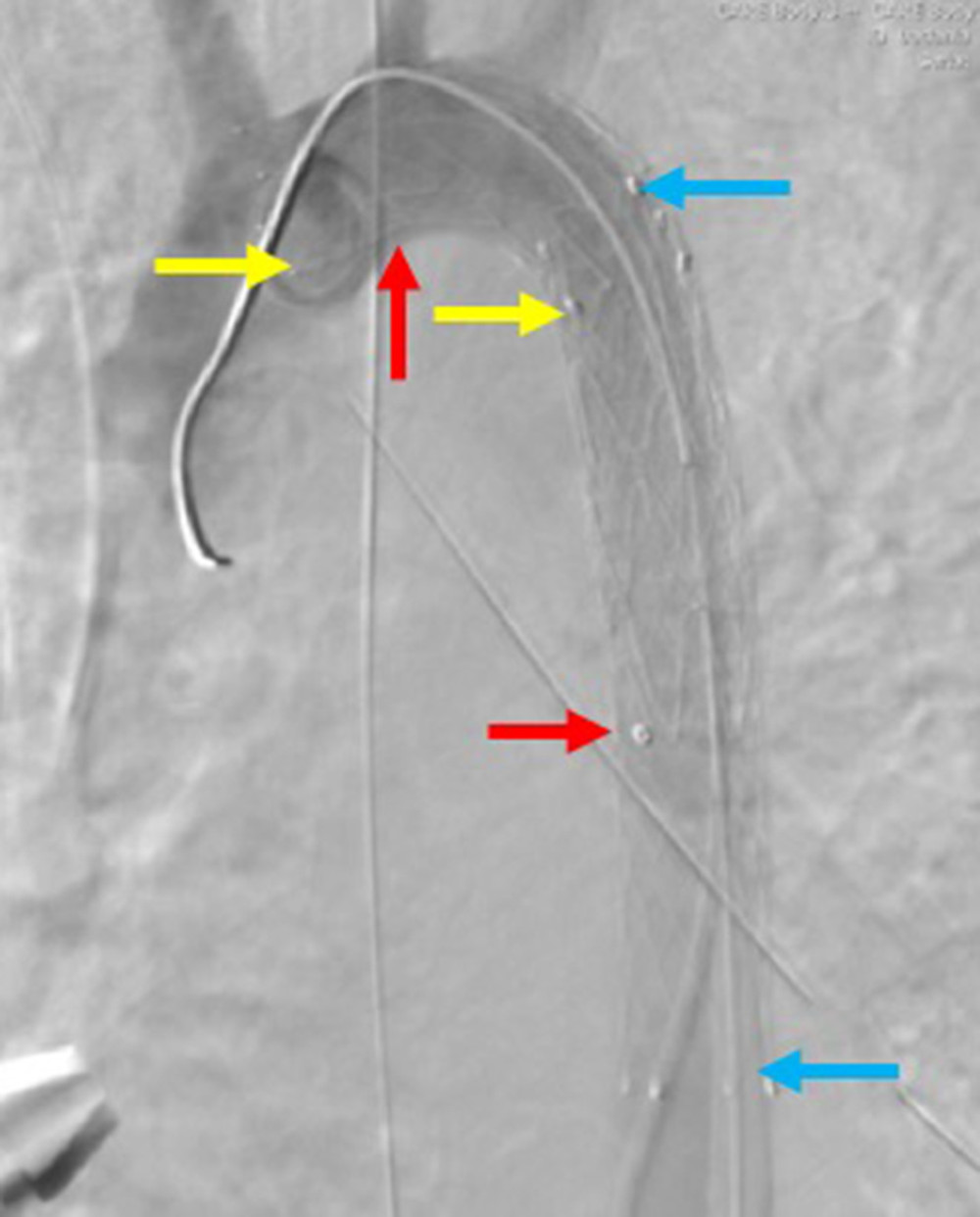Final result of primary endovascular intervention. Blue arrows: covered stent (Fluency, 14/80 mm, Bard, Murray Hill, USA); Red arrows: iliac stentgraft (15/16×93 mm, Jotec, Hechingen, Germany); Yellow arrows: self-expandable stent (Protégé GPS, 14/16 mm, Medtronic, Minneapolis, USA).