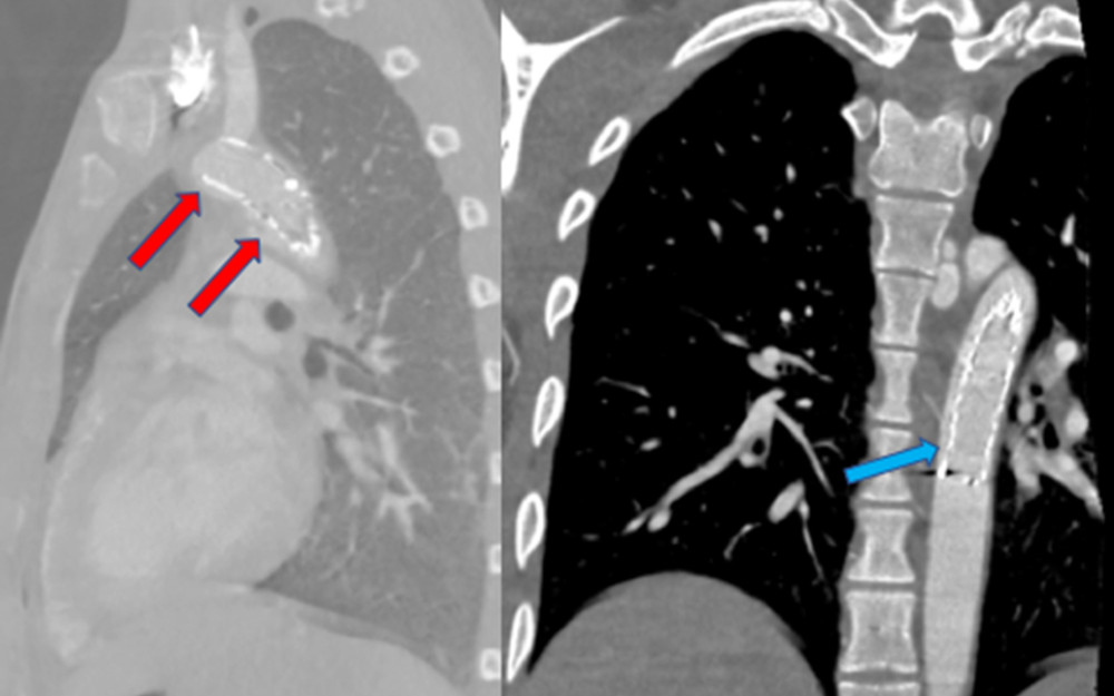Massive type-IA and -IB endoleaks. Red arrow: type-IA endoleak; Blue arrow: type-IB endoleak. Of the five main types of endoleaks, a Type I endoleak is the most dangerous, and necessitates urgent attention due to a high risk of aneurysm rupture.