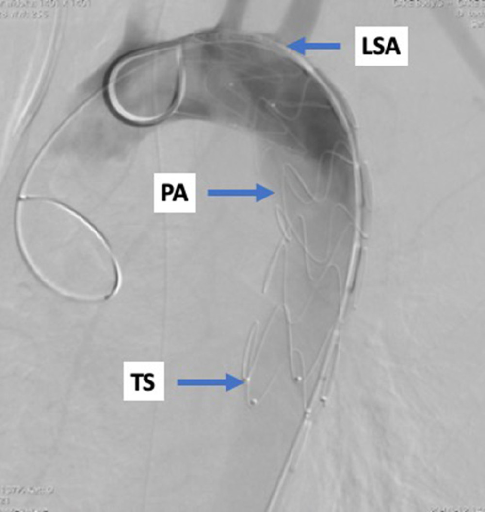 Final result of secondary endovascular treatment (* aortic rupture and pseudoaneurysm exclusion). LSA – left subclavian artery; PA – pseudoaneurysm; TS – thoracic stentgraft.