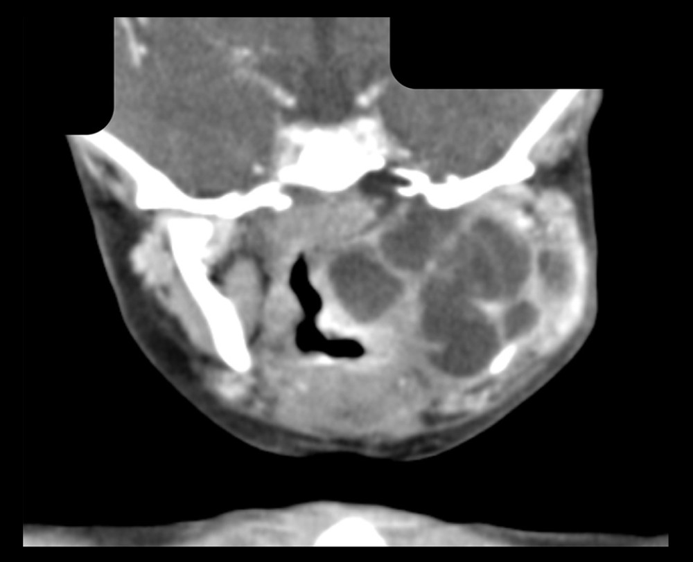 CT – coronal section showing the mass and the airway narrowing.
