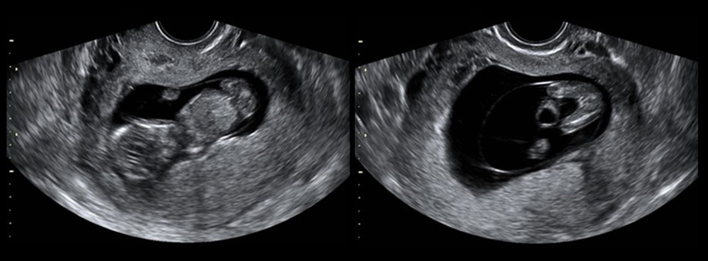 Fetal ultrasonography at 12 weeks and 4 days of gestation age. There was a cystic lesion at the fetal umbilical region.