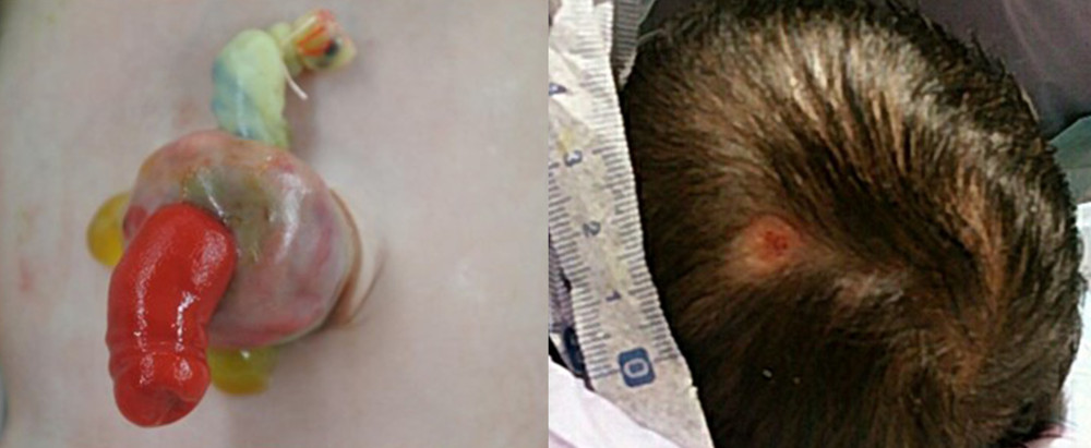 Physical findings at birth. Omphalocele with omphalomesenteric fistula protruded from the umbilicus, and there was a scalp defect on the head.