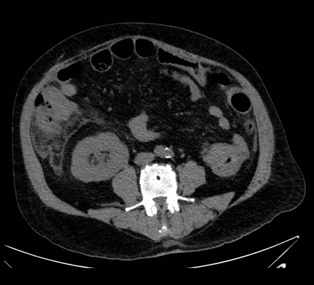 Abdominal computed tomography without contrast showing marked circumferential wall thickening of the cecum with ulcerations and air along the thickened wall extending to the right lateral abdominal wall.