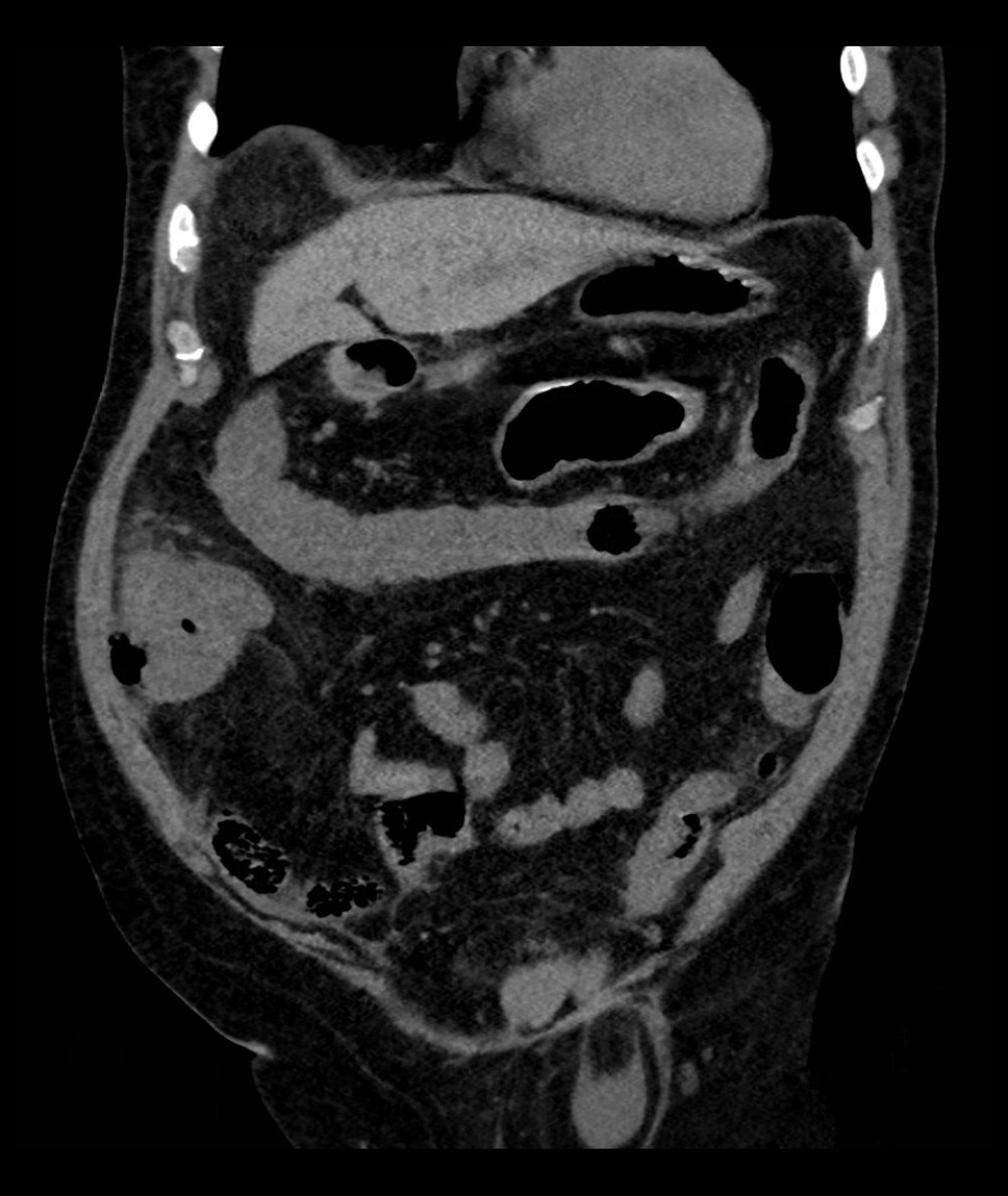 Abdominal computed tomography without contrast showing marked circumferential wall thickening of the cecum with ulcerations and air along the thickened wall extending to the right lateral abdominal wall.