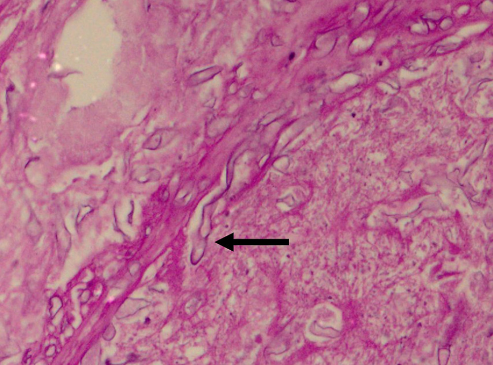 Histopathological slide of the colon showing broad pauciseptate hyphae (arrow) (periodic acid-Schiff stain, 20× magnification).