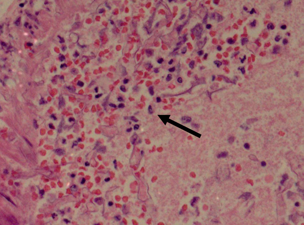 Histopathological slide showing evidence of thrombosis and angioinvasion (arrow) of vascular wall by the mucormycosis seen against a background of a neutrophil and macrophage in a hematoxylin and eosin stain (40× magnification).