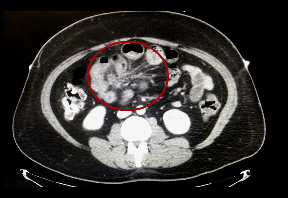 CT scan of abdomen with contrast showing a focus of mesenteric distortion (circled) and infiltration within the right mid abdomen resulting in partial small bowel obstruction with associated mesenteric lymphadenopathy.