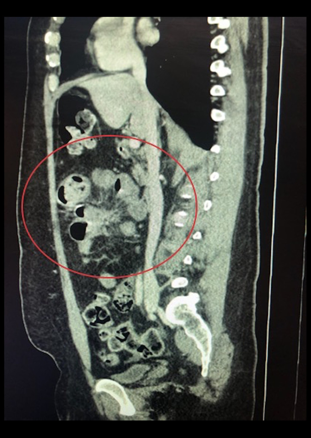CT scan of abdomen with contrast, sagittal view, emphasizing the focus of mesenteric distortion (circled) and small bowel dilation with associated mesenteric lymphadenopathy.