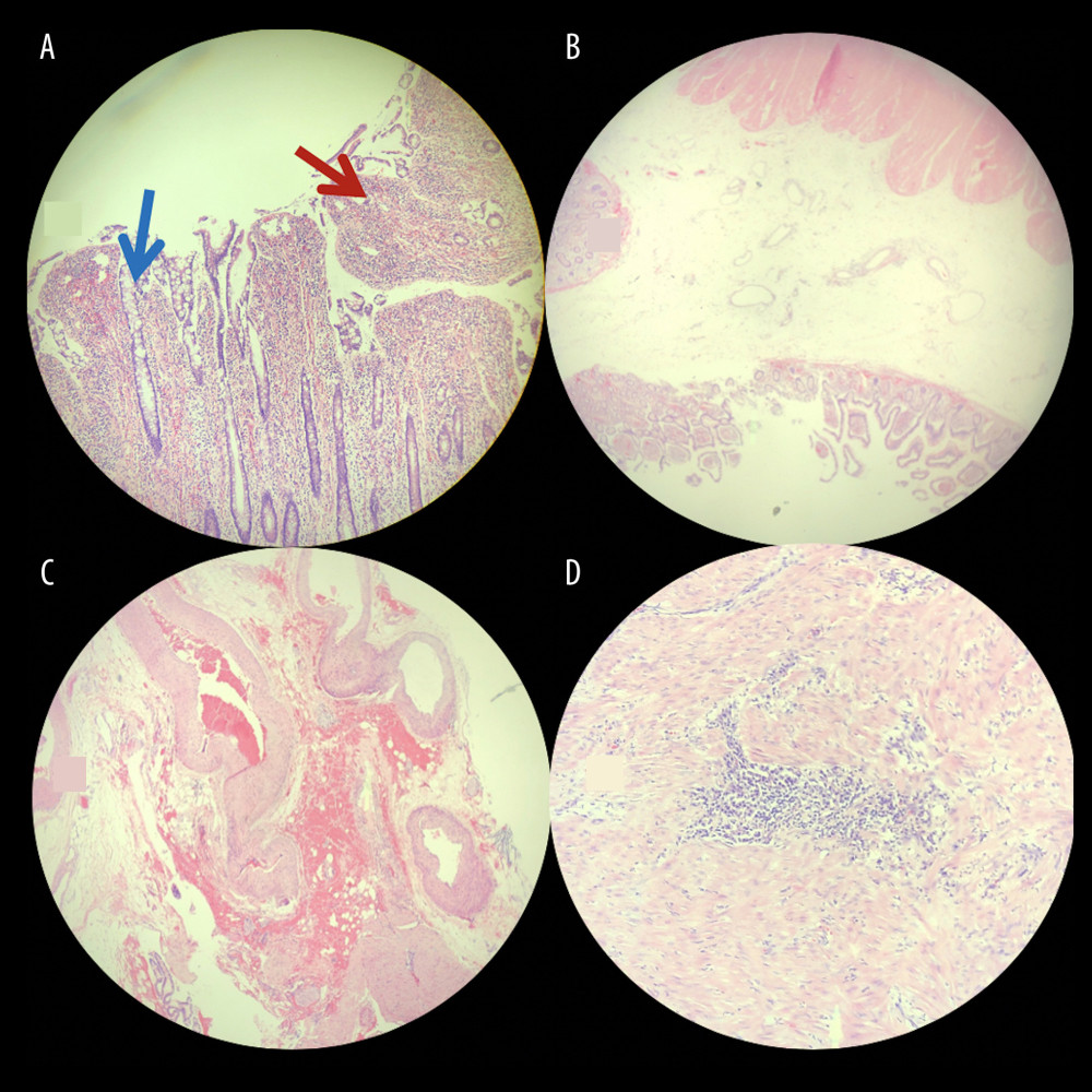 Early ischemic changes seen in the ileum specimen, including loss of glandular structures (A, red arrow), with normal tissue comparison (A, blue arrow), and submucosal edema (B). Mesenteric findings of thickened blood vessels and hemorrhage (C) as well as inflammatory infiltrates (D).