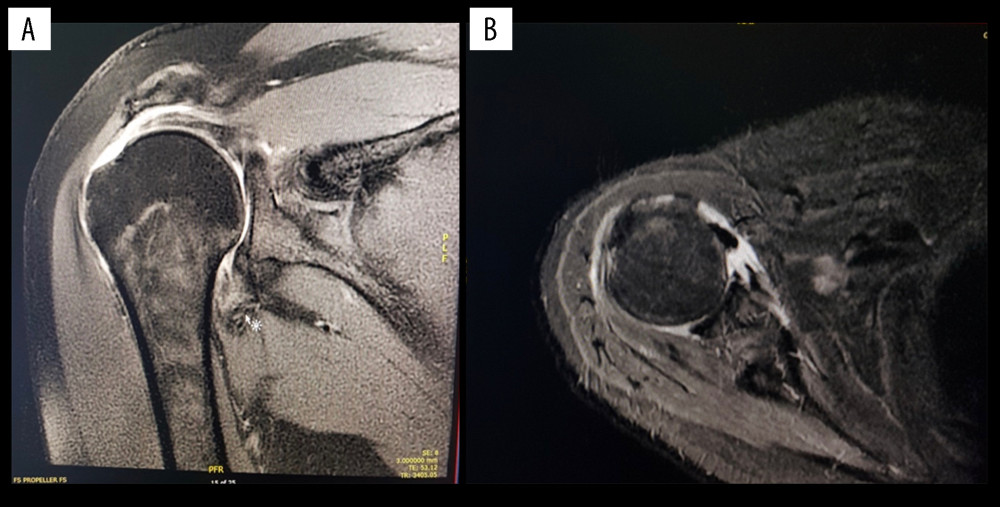(A) Right shoulder magnetic resonance imaging without contrast (coronal view) showing retracted massive rotator cuff tear. (B) Right shoulder magnetic resonance imaging without contrast (axial view) showing retracted subscapularis tear with subluxation of the long head of biceps.