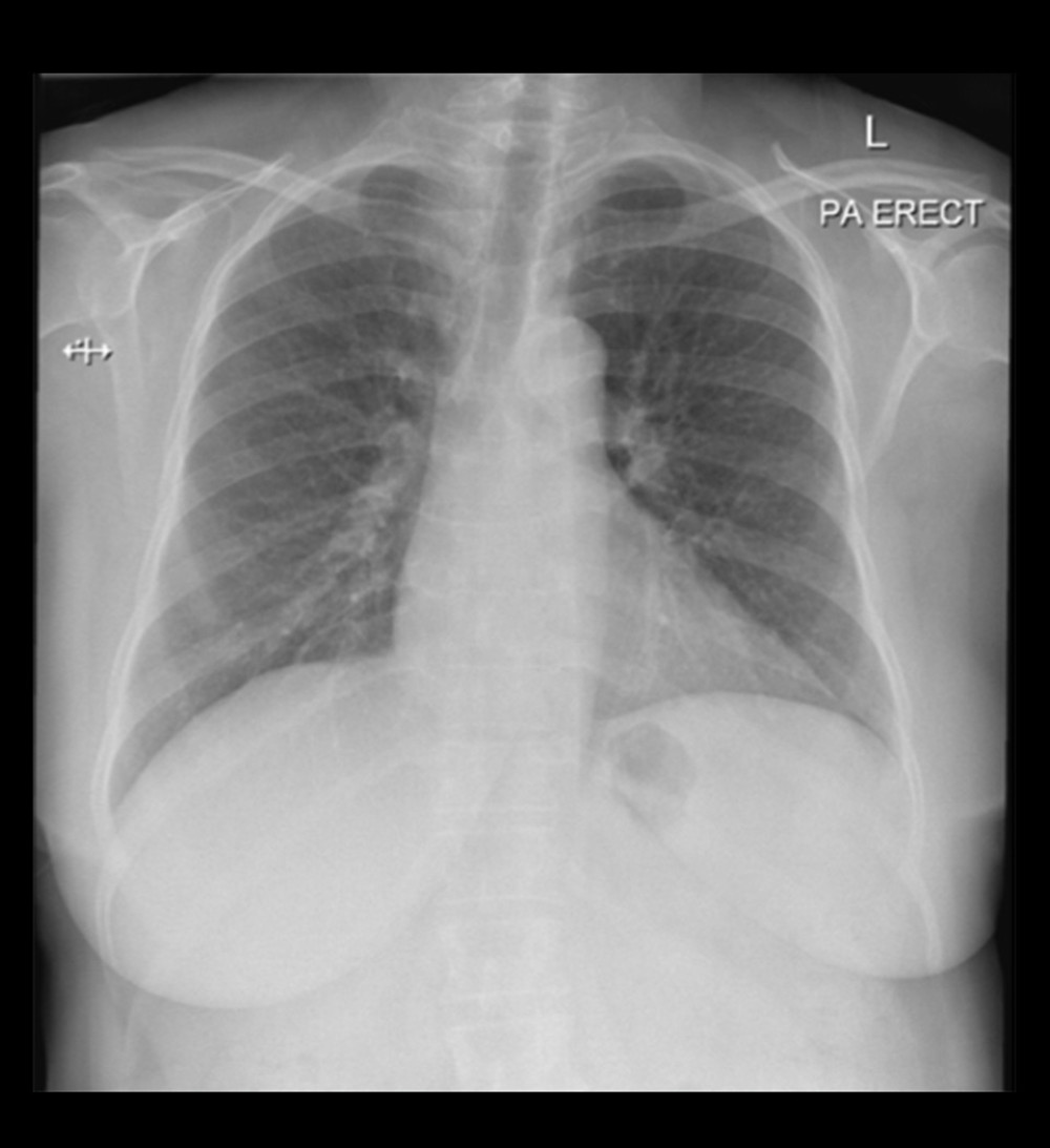 Posteroanterior erect chest radiograph 1 week before surgery showing no abnormalities.