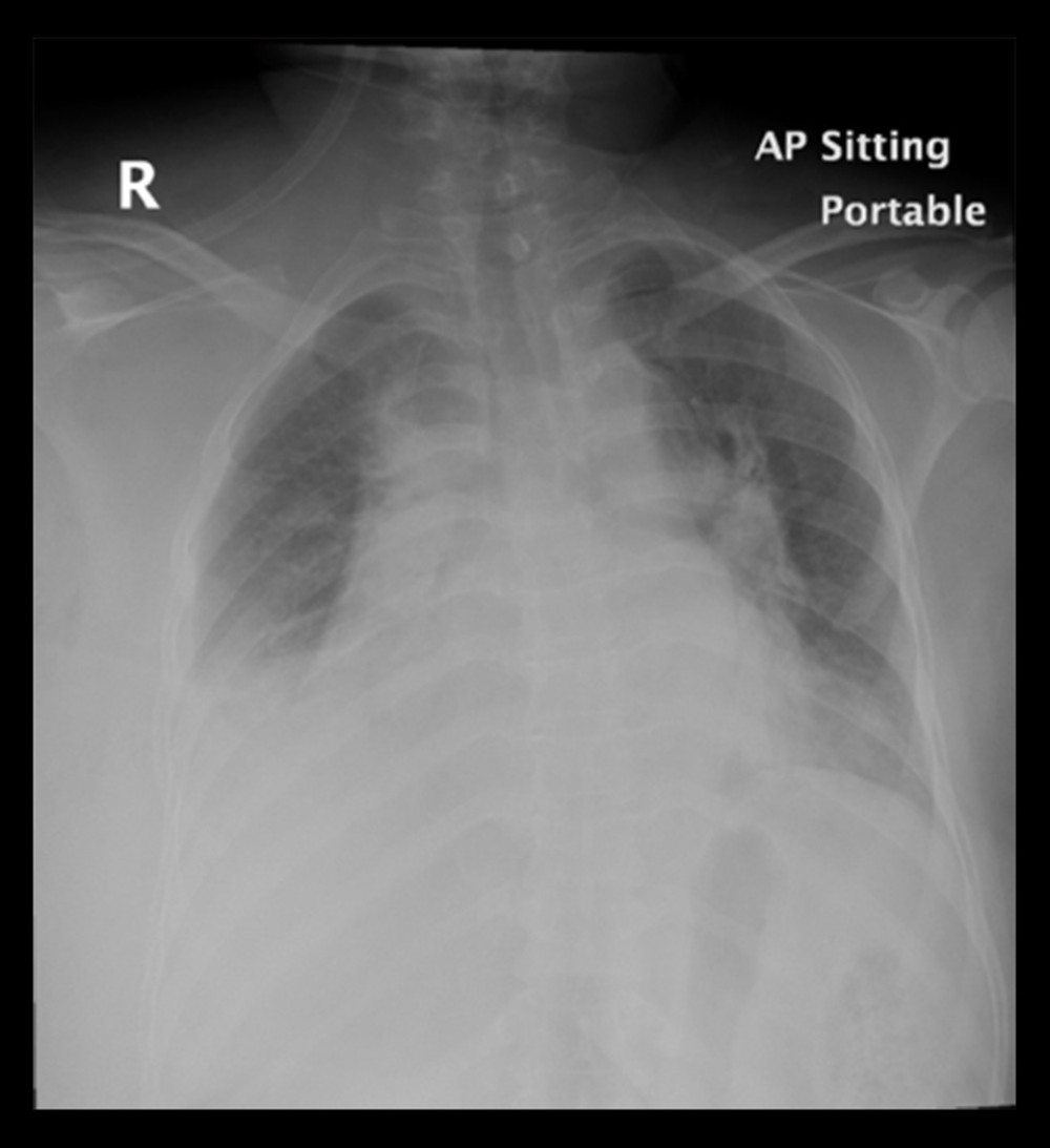 Anteroposterior semisitting portable chest radiograph immediately after surgery showing an obliterated right costophrenic angle by homogenous opacity, suggesting right pleural effusion producing adjacent consequent passive minimal subsegmental atelectasis accompanied by bilateral hilar congestion more on the left side.