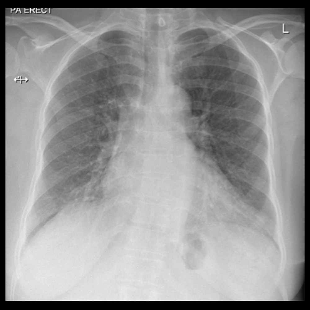 Posteroanterior erect chest radiograph on the fourth postoperative day showed significant improvement of pulmonary edema and pleural effusion.