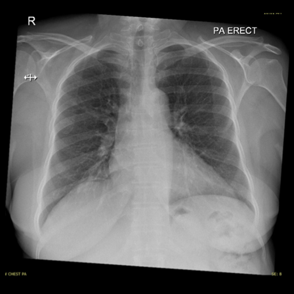 Posteroanterior erect chest radiograph at 2-week follow-up revealed nearly complete resolution of pulmonary edema and pleural effusion.