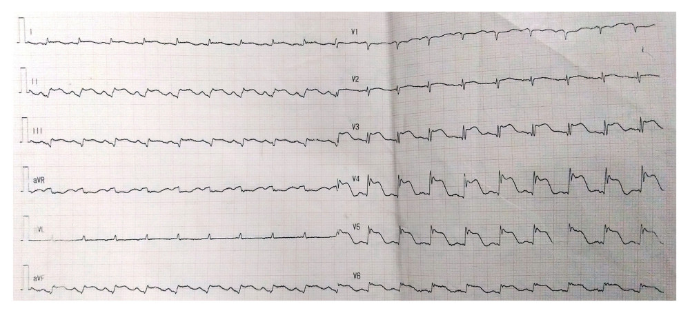 ECG pre-surgery showed diffused J point and ST-segment elevation.