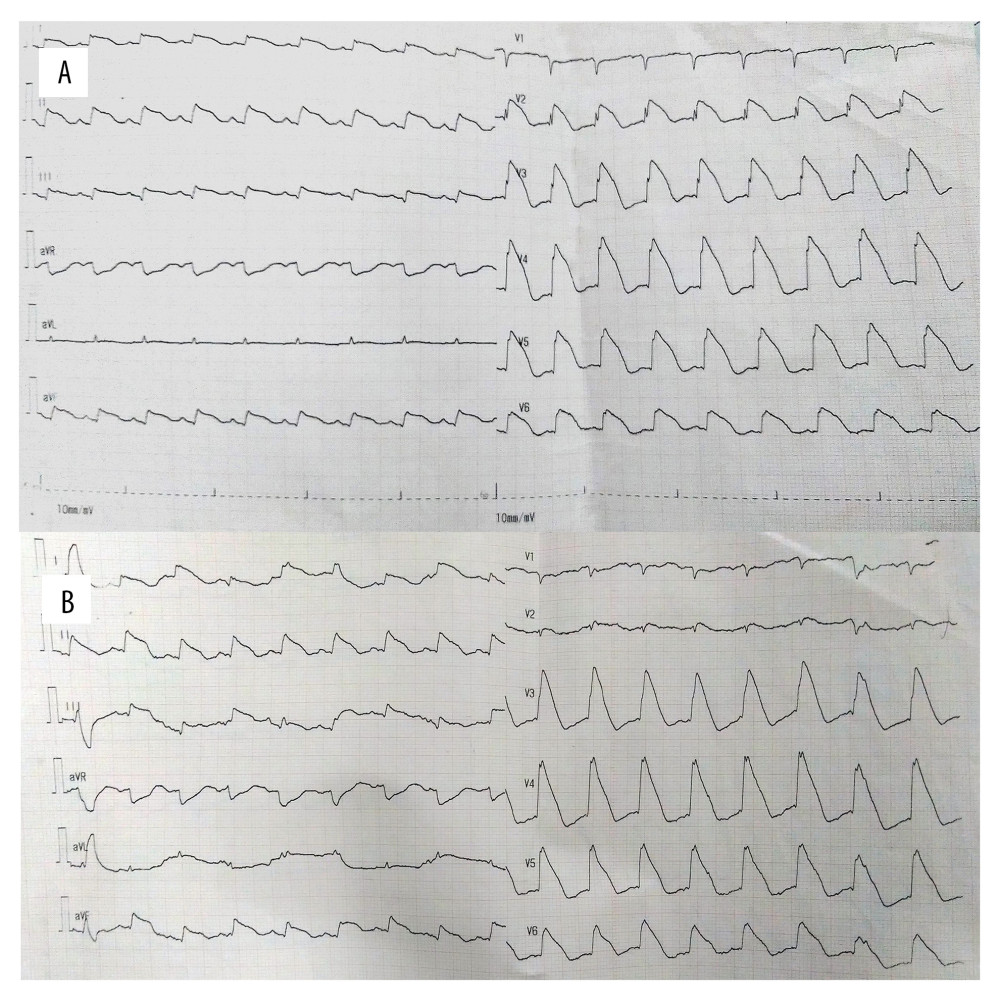 Post-thrombolytic ECG showed higher degree of ST-segment elevation. (A) One hour post-thrombolytic, (B) Two hours after thrombolysis.