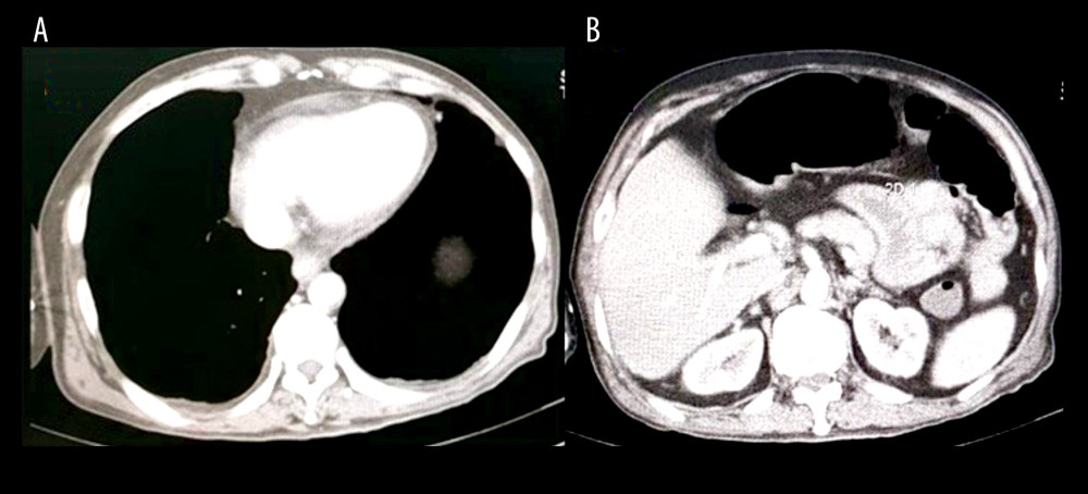 (A) CT scan contrast showed enhance pericardium, supporting pericarditis, (B) Mucosal thickening of enteritis.