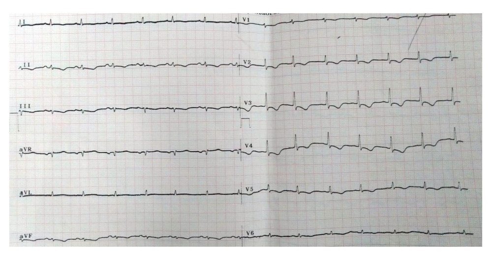 ECG on the third day of acute myopericarditis treatment.