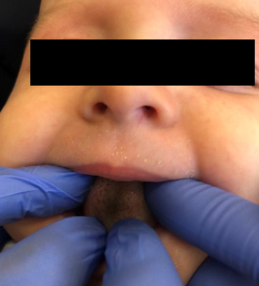 Black hairy tongue in an infant.