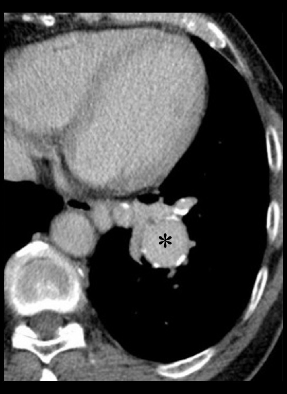 Axial CECT image in the portal venous phase showing an enhancing oval-shaped lesion (asterix) in the lower lobe of the left lung. Portions of its walls show mural calcification. Adjacent to it was a conglomerate of tortuous and dilated vessels deriving its arterial supply from the descending thoracic aorta.