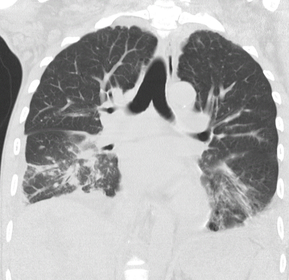 Coronal image of initial CT of the chest shows various parenchymal abnormalities, including small areas of ground-glass infiltrates in the lingual and RLL. There is significant peribronchial thickening and diffuse nodularity of the bronchovascular bundles, suggestive of pulmonary Kaposi sarcoma.