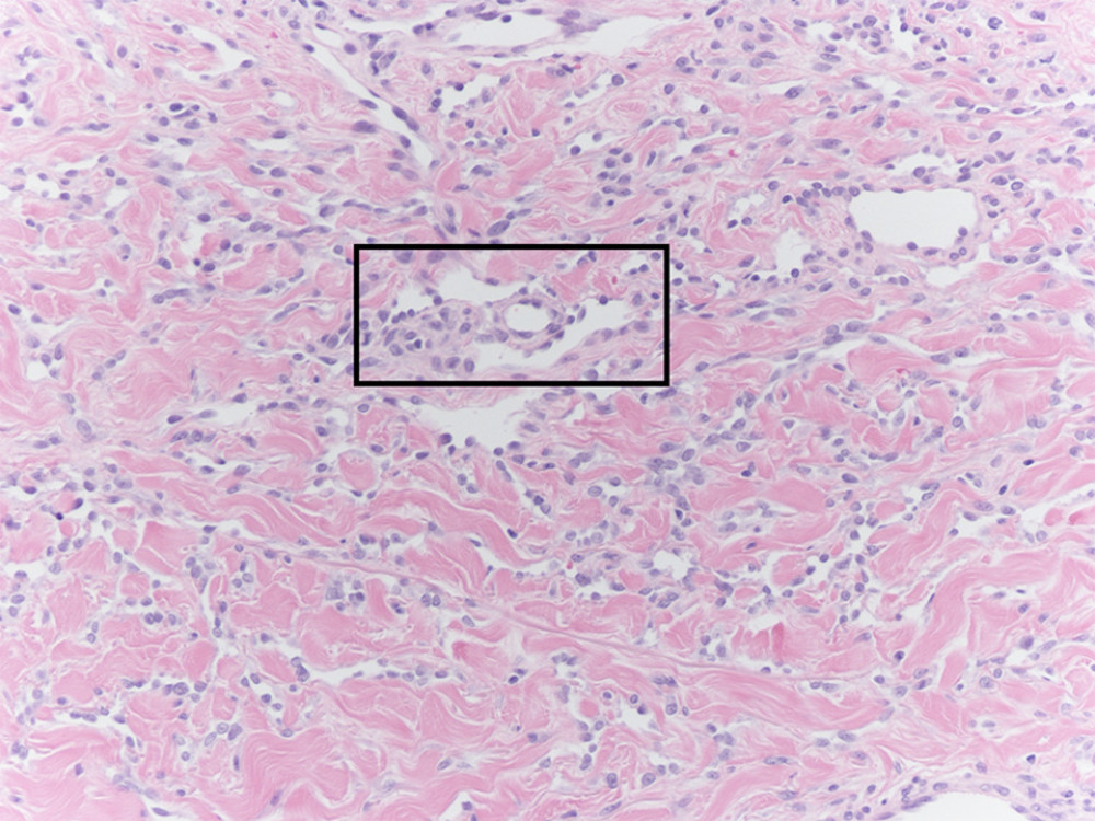 In this high-power image we can observe infiltrate consisting of atypical spindled endothelial cells forming vascular channels intersecting between collagen bundles. Promontory sign (normal vessel enveloped in atypical vascular space) is present in the black box. This characteristic is not specific for KS and can also be seen in other vascular neoplasms such as angiosarcoma.
