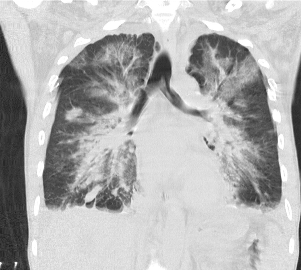 Coronal image of repeated CT of the chest demonstrates interval worsening of patchy consolidative, ground-glass, and reticulonodular opacities in both lungs, greatest within the central portions of the lungs. Additionally, stable moderate right and mild interval increased moderate left pleural effusions are present.