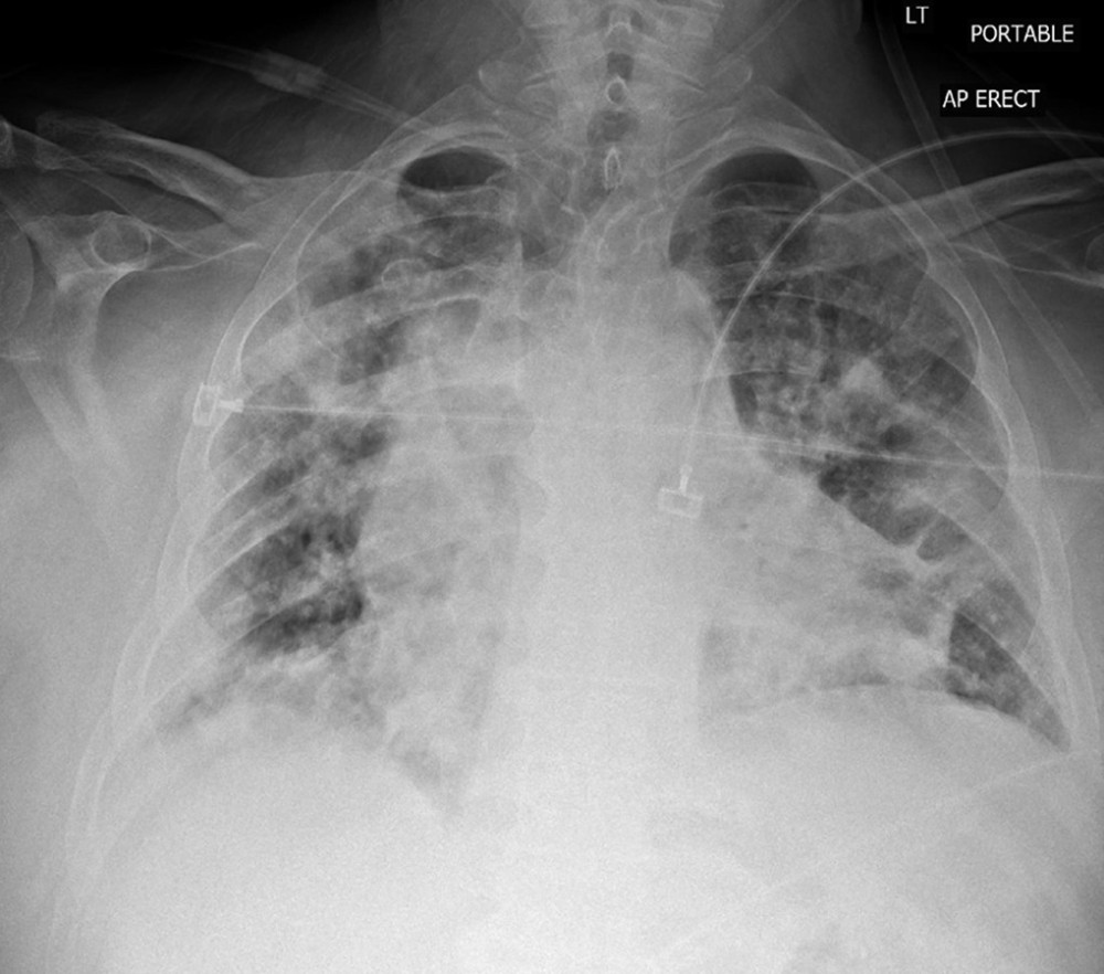 CXR upon admission showing diffuse interstitial and airspace opacities in the bilateral lungs, right >left.