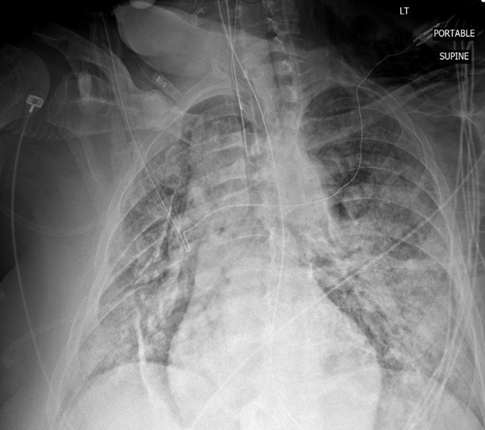 CXR on day 3 showing worsening of bilateral diffuse interstitial and airspace opacities.