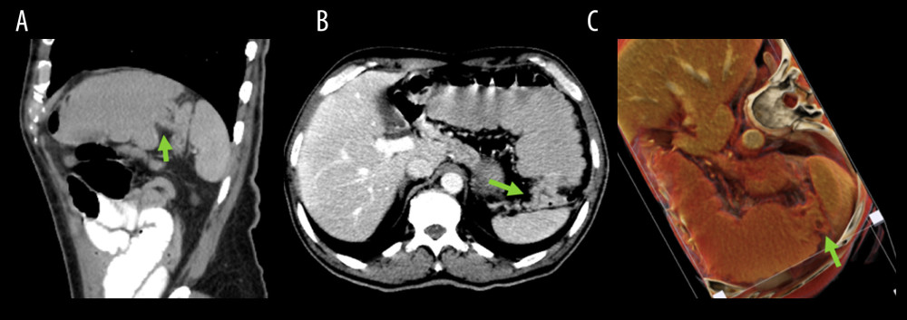 (A–C) Selected sagittal (A) and Axial (B) computed tomography scans of the upper abdomen with intravenous contrast in the portosystemic venous phase and oral contrast in our patient, who presented with suspected bowel obstruction. The images show focal circumferential narrowing of the descending colon at the splenic flexure, resulting in an “apple core” appearance that is pathognomonic for colonic adenocarcinoma (green arrow) and leads to high-grade bowel obstruction.