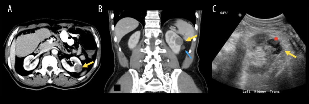 (A) Intravenous contrast-enhanced computed tomography scan at the level of the kidneys in the axial plane showing an incidental cortical exophytic interpolar renal lesion (yellow arrow) with enhancement that is suspicious for renal cell carcinoma. (B) Another smaller exophytic lesion (blue arrow) is seen in the coronal image of the left renal cortex with no enhancement, consistent with a cyst (blue arrow). (C) Ultrasonography performed on the same day showed the suspicious lesion (yellow arrow). The lesion’s heterogenous echogenicity, solid component (red star), and lack of posterior acoustic shadow confirmed that it was solid.